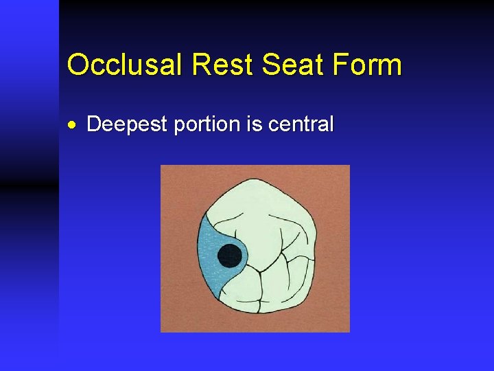 Occlusal Rest Seat Form · Deepest portion is central 