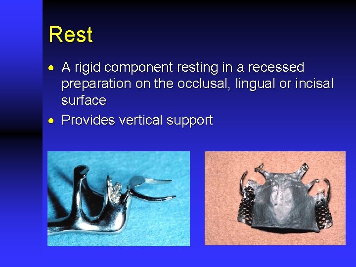 Rest · A rigid component resting in a recessed preparation on the occlusal, lingual