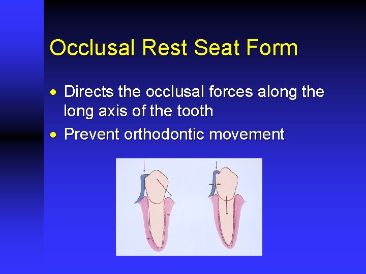 Occlusal Rest Seat Form · Directs the occlusal forces along the long axis of