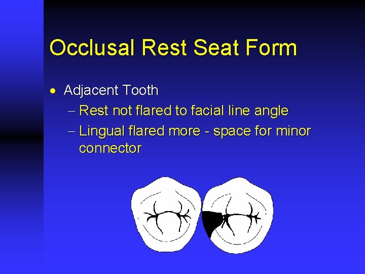 Occlusal Rest Seat Form · Adjacent Tooth - Rest not flared to facial line