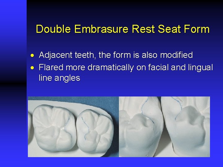 Double Embrasure Rest Seat Form · Adjacent teeth, the form is also modified ·