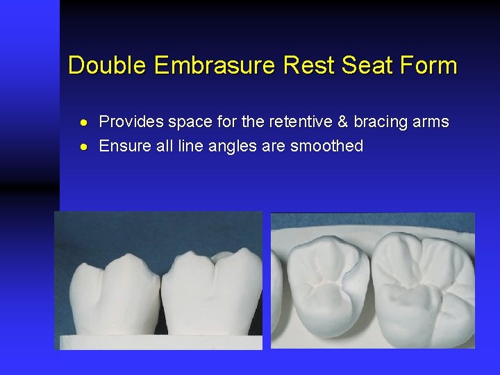 Double Embrasure Rest Seat Form · Provides space for the retentive & bracing arms