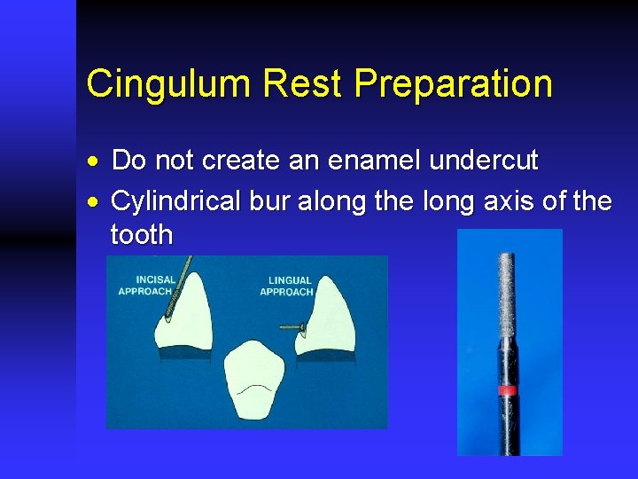 Cingulum Rest Preparation · Do not create an enamel undercut · Cylindrical bur along