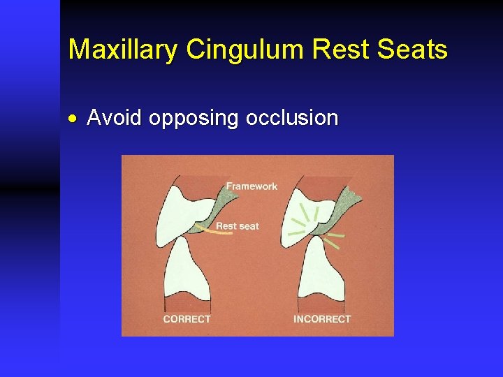 Maxillary Cingulum Rest Seats · Avoid opposing occlusion 