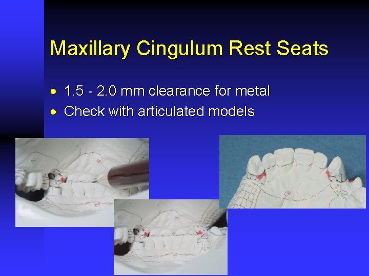 Maxillary Cingulum Rest Seats · 1. 5 - 2. 0 mm clearance for metal