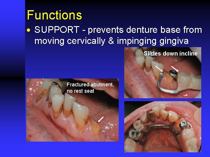 Functions · SUPPORT - prevents denture base from moving cervically & impingingiva Slides down