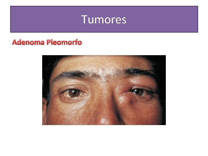 Tumores Adenoma Pleomorfo 