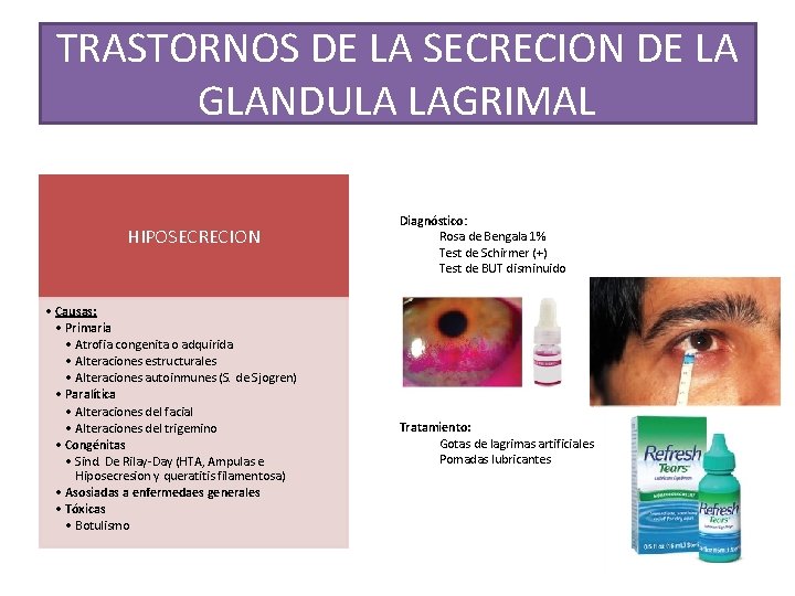 TRASTORNOS DE LA SECRECION DE LA GLANDULA LAGRIMAL HIPOSECRECION • Causas: • Primaria •