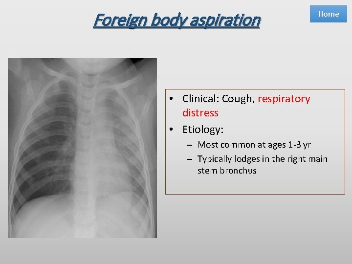 Foreign body aspiration Home • Clinical: Cough, respiratory distress • Etiology: – Most common