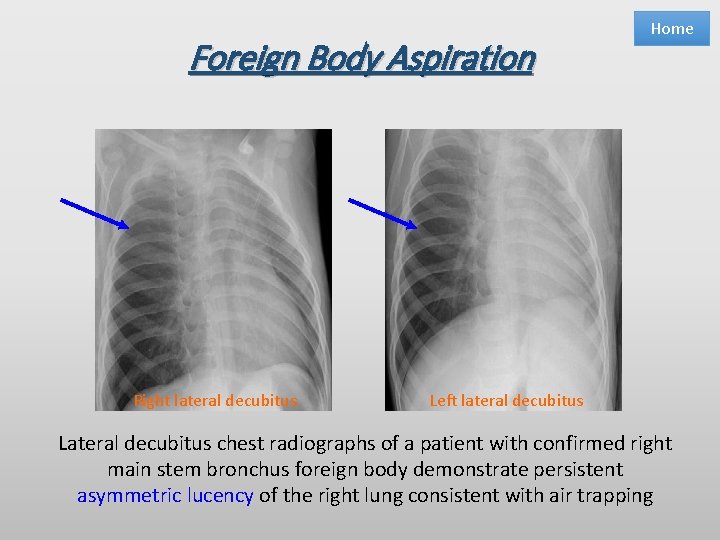 Foreign Body Aspiration Right lateral decubitus Home Left lateral decubitus Lateral decubitus chest radiographs