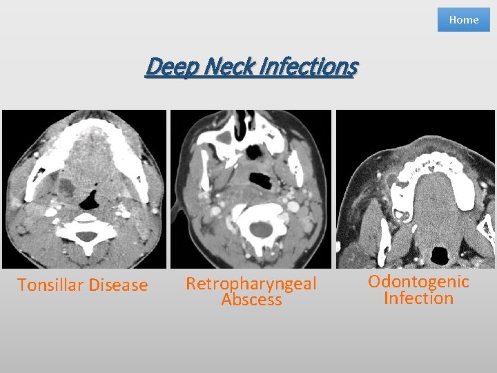 Home Deep Neck Infections Tonsillar Disease Retropharyngeal Abscess Odontogenic Infection 