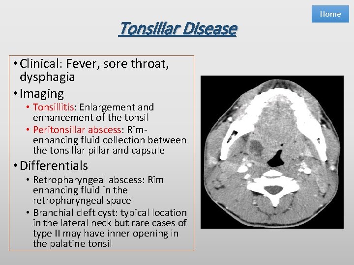 Tonsillar Disease • Clinical: Fever, sore throat, dysphagia • Imaging • Tonsillitis: Enlargement and