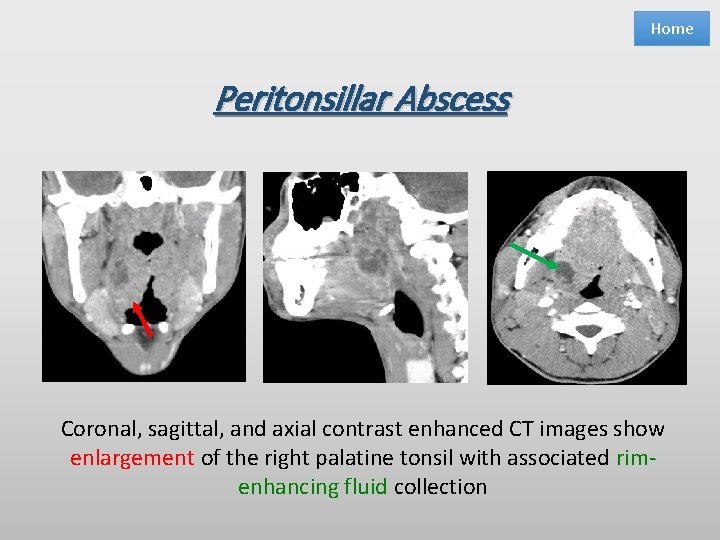 Home Peritonsillar Abscess Coronal, sagittal, and axial contrast enhanced CT images show enlargement of