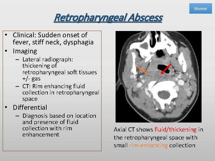 Retropharyngeal Abscess Home • Clinical: Sudden onset of fever, stiff neck, dysphagia • Imaging