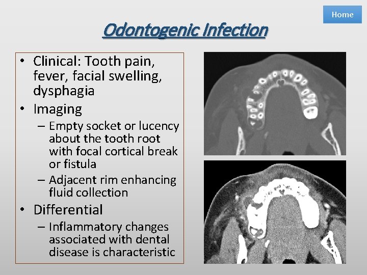 Odontogenic Infection • Clinical: Tooth pain, fever, facial swelling, dysphagia • Imaging – Empty