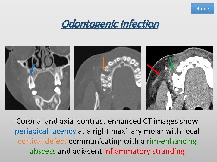 Home Odontogenic Infection Coronal and axial contrast enhanced CT images show periapical lucency at