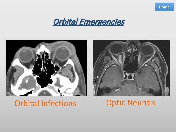 Home Orbital Emergencies Orbital Infections Optic Neuritis 