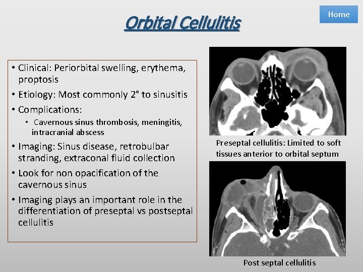 Home Orbital Cellulitis • Clinical: Periorbital swelling, erythema, proptosis • Etiology: Most commonly 2°