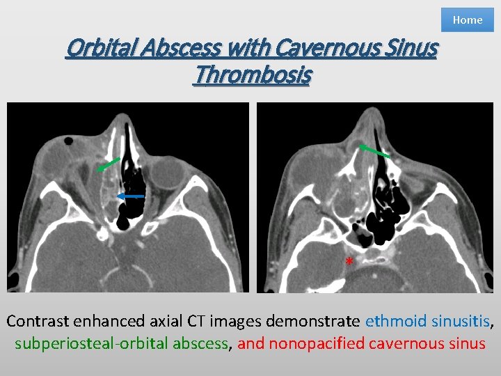 Home Orbital Abscess with Cavernous Sinus Thrombosis * Contrast enhanced axial CT images demonstrate