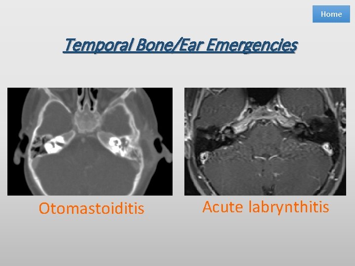 Home Temporal Bone/Ear Emergencies Otomastoiditis Acute labrynthitis 