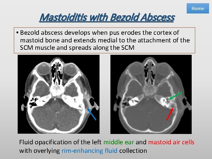 Mastoiditis with Bezold Abscess Home • Bezold abscess develops when pus erodes the cortex