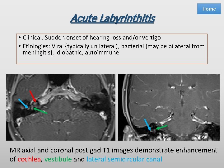 Acute Labyrinthitis Home • Clinical: Sudden onset of hearing loss and/or vertigo • Etiologies: