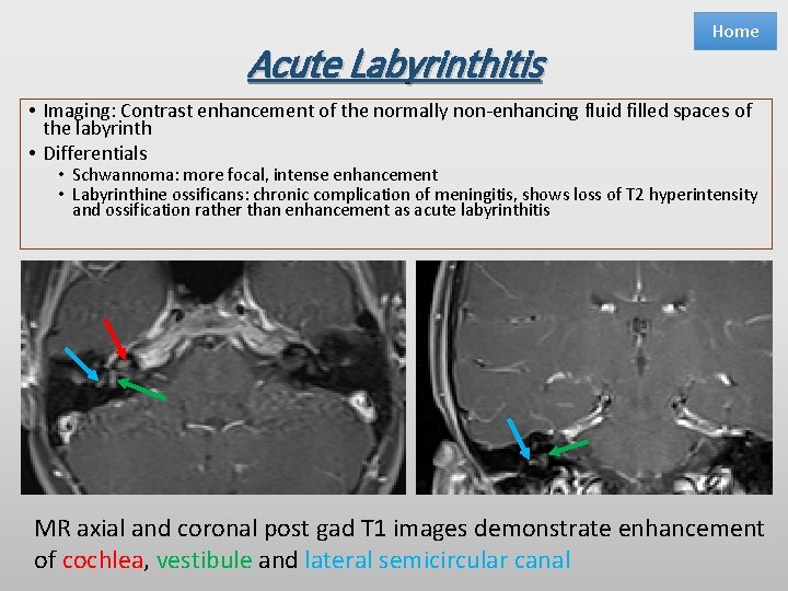 Acute Labyrinthitis Home • Imaging: Contrast enhancement of the normally non-enhancing fluid filled spaces