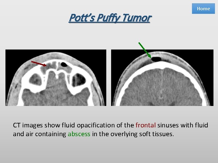 Pott’s Puffy Tumor Home CT images show fluid opacification of the frontal sinuses with
