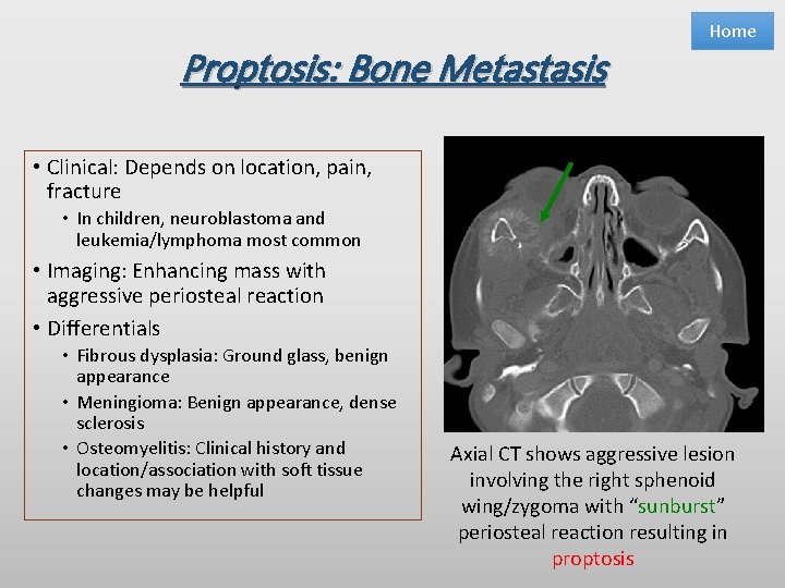 Proptosis: Bone Metastasis Home • Clinical: Depends on location, pain, fracture • In children,