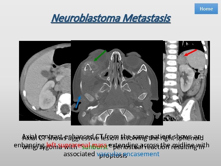 Neuroblastoma Metastasis Home Axial CTlesion from involving the same the patient an Axial contrast