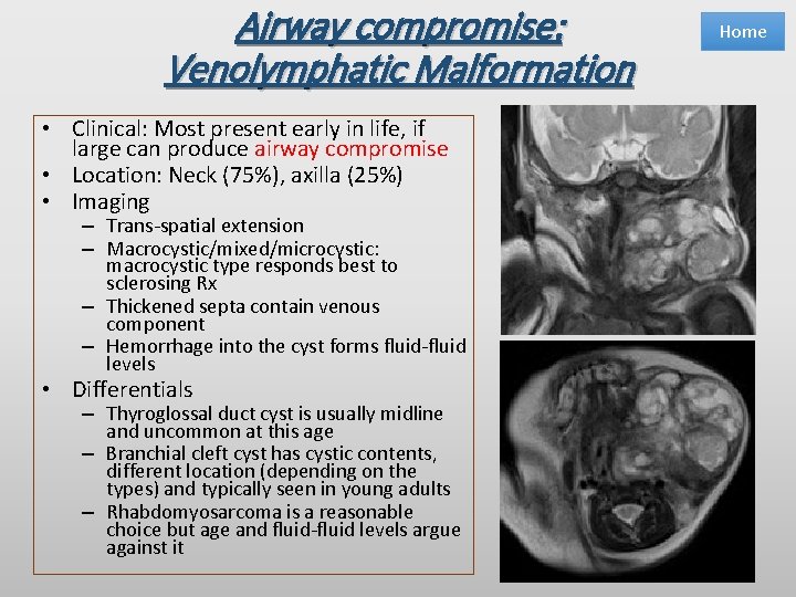 Airway compromise: Venolymphatic Malformation • Clinical: Most present early in life, if large can