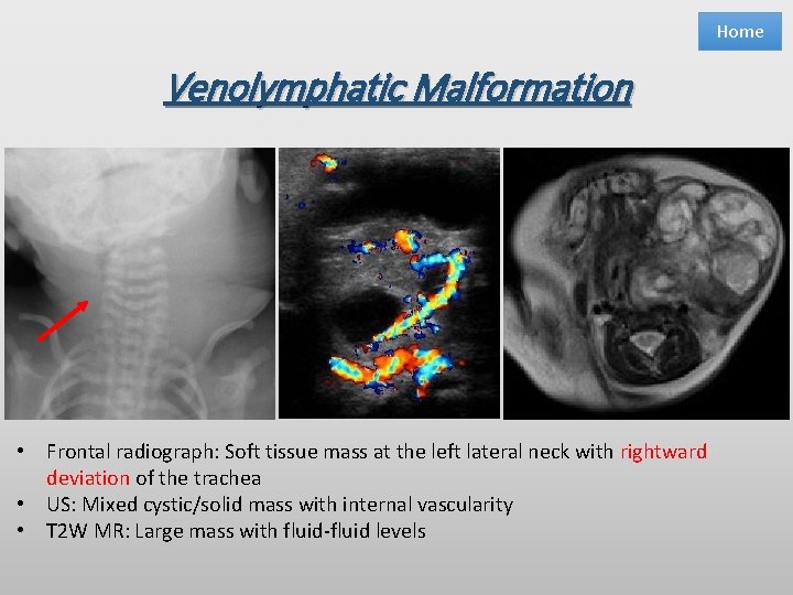 Home Venolymphatic Malformation • Frontal radiograph: Soft tissue mass at the left lateral neck