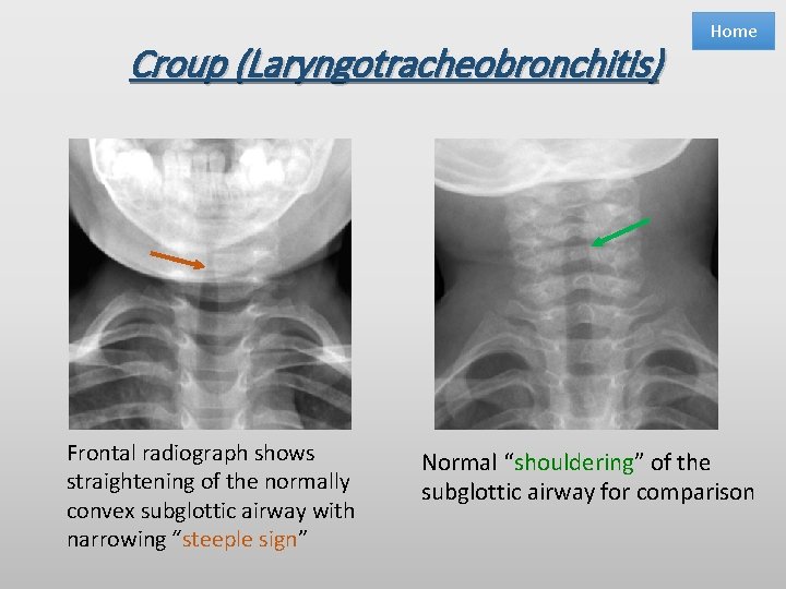 Croup (Laryngotracheobronchitis) Frontal radiograph shows straightening of the normally convex subglottic airway with narrowing