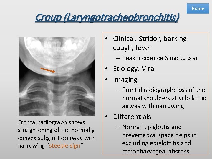 Croup (Laryngotracheobronchitis) Home • Clinical: Stridor, barking cough, fever – Peak incidence 6 mo