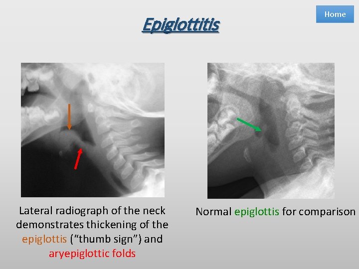 Epiglottitis Lateral radiograph of the neck demonstrates thickening of the epiglottis (“thumb sign”) and