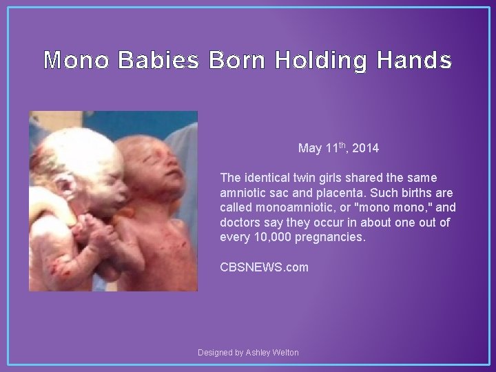 Mono Babies Born Holding Hands May 11 th, 2014 The identical twin girls shared