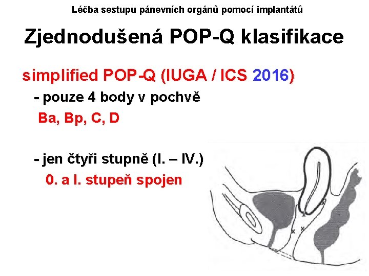 Léčba sestupu pánevních orgánů pomocí implantátů Zjednodušená POP-Q klasifikace simplified POP-Q (IUGA / ICS
