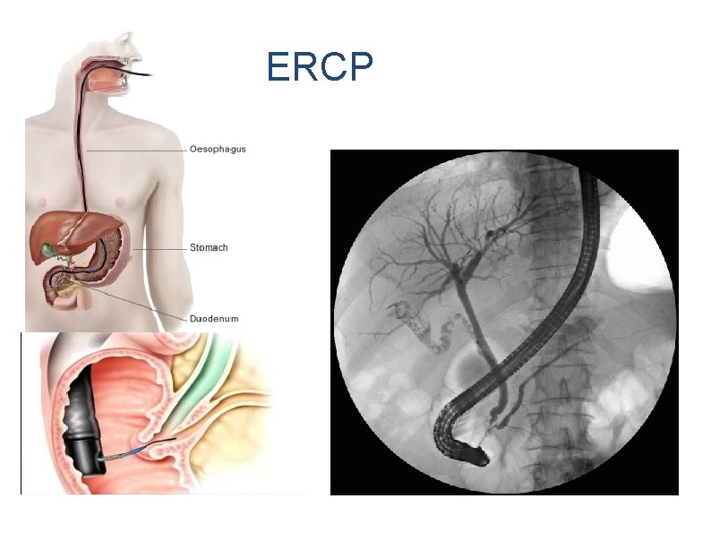 ERCP 