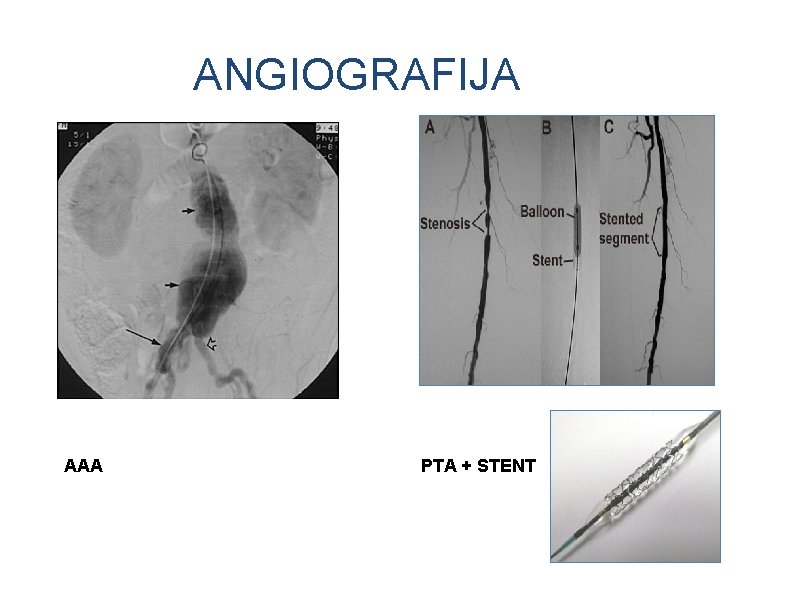 ANGIOGRAFIJA AAA PTA + STENT 