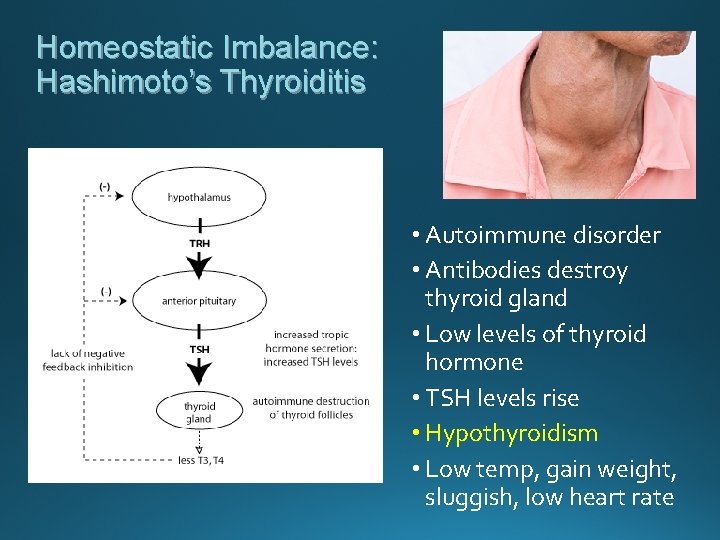 Homeostatic Imbalance: Hashimoto’s Thyroiditis • Autoimmune disorder • Antibodies destroy thyroid gland • Low