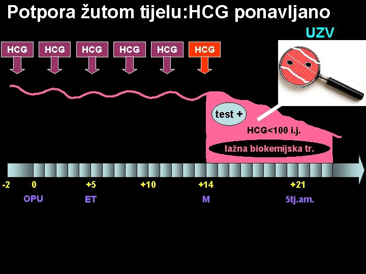 Potpora žutom tijelu: HCG ponavljano UZV HCG HCG HCG test + HCG<100 i. j.