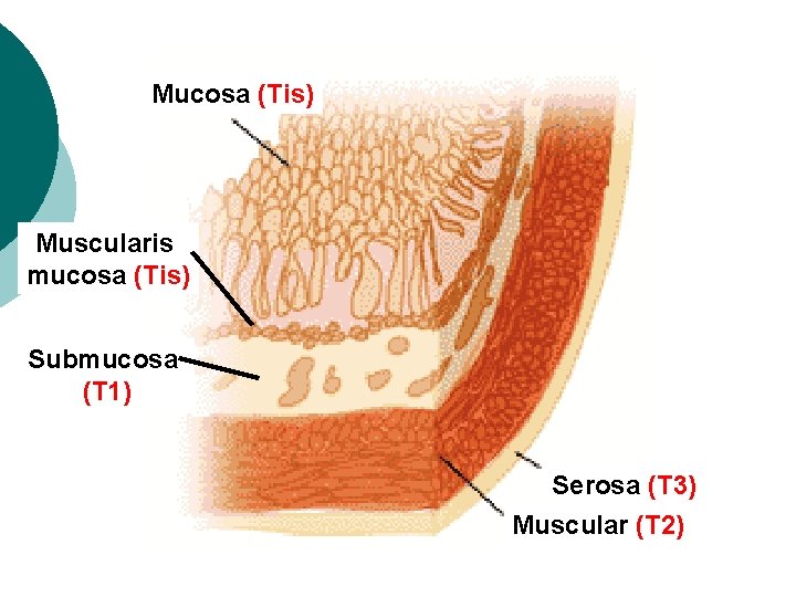 Mucosa (Tis) Muscularis mucosa (Tis) Submucosa (T 1) Serosa (T 3) Muscular (T 2)