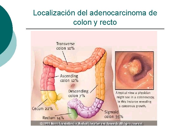 Localización del adenocarcinoma de colon y recto 