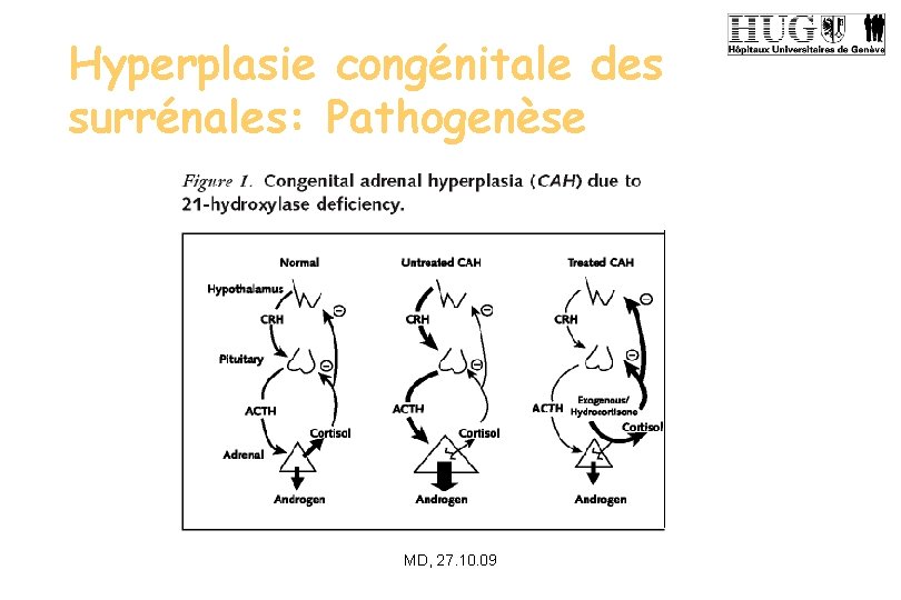 Hyperplasie congénitale des surrénales: Pathogenèse MD, 27. 10. 09 
