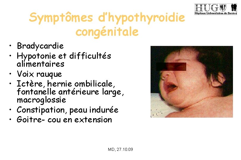 Symptômes d’hypothyroidie congénitale • Bradycardie • Hypotonie et difficultés alimentaires • Voix rauque •