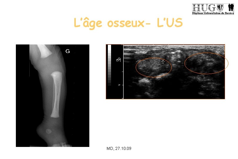 L’âge osseux- L’US MD, 27. 10. 09 