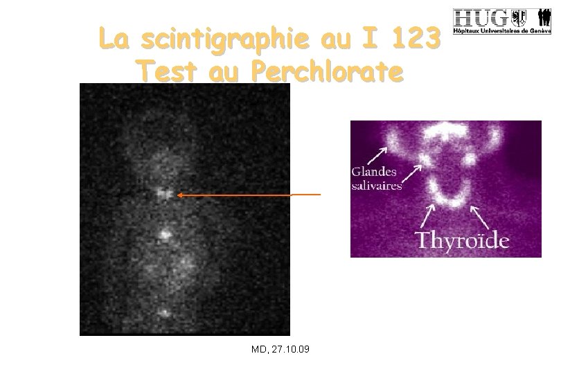 La scintigraphie au I 123 Test au Perchlorate MD, 27. 10. 09 