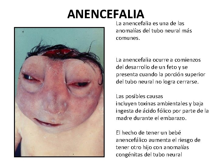 ANENCEFALIA La anencefalia es una de las anomalías del tubo neural más comunes. La