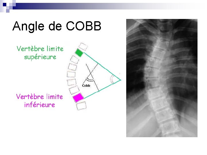 Angle de COBB 