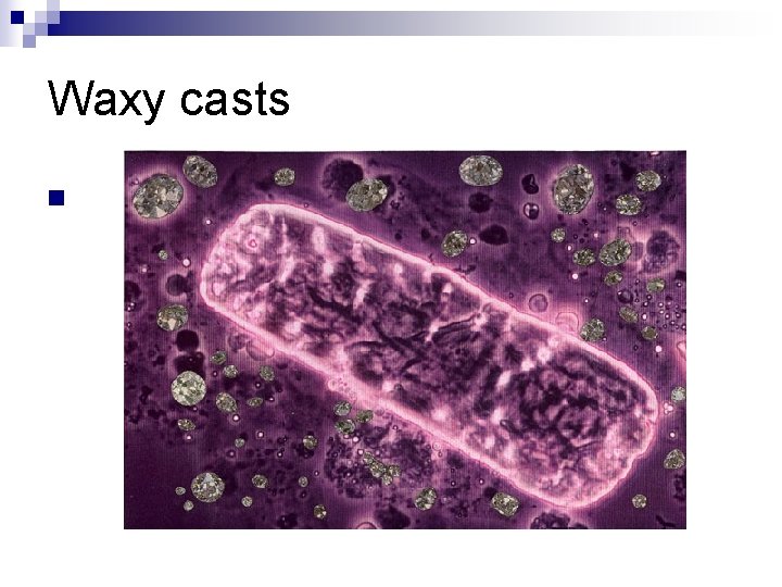 Waxy casts n 